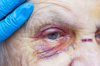 Nursing Home Abuse